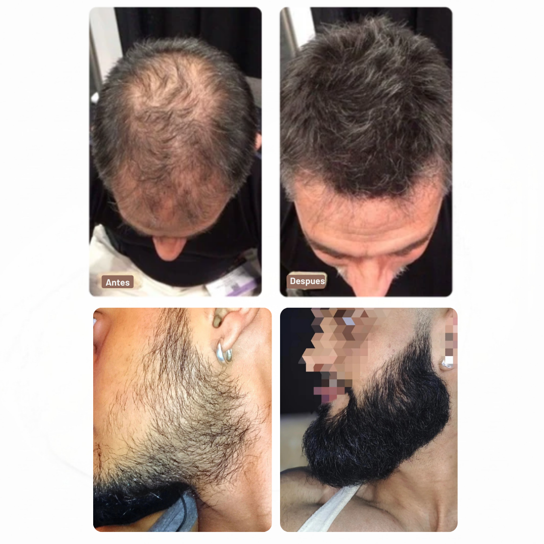 VIREON® Serum Avanzado para el Crecimiento de Barba y Cabello